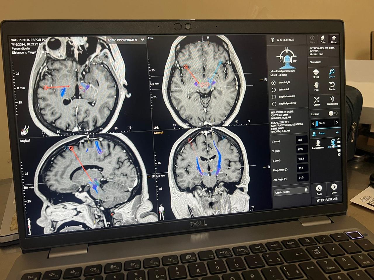 cirurgia-parkinson-1